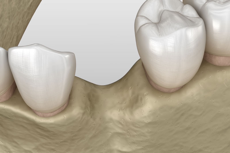 jaw bone loss graphic