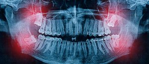 Panoramic,X-ray,Image,Of,Teeth.,Problem,With,Wisdom,Tooth